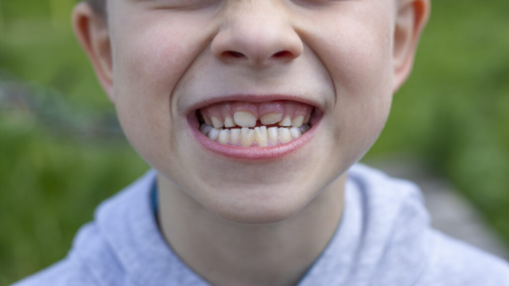 Children's teeth The molar grows in the second row Anomalies of tooth growth