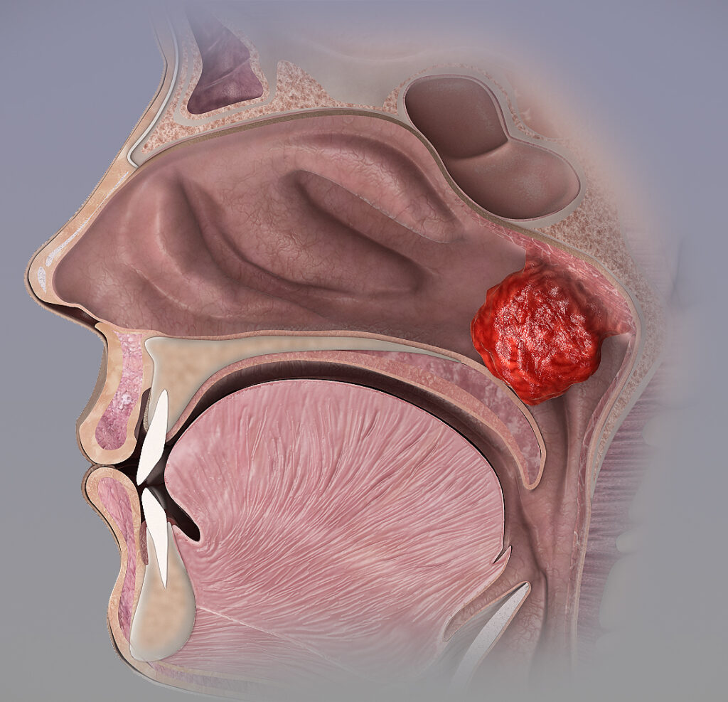 trzeci migdał u dziecka