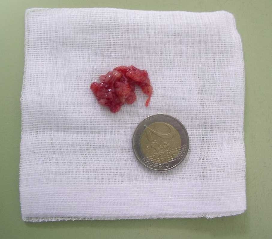 trzeci migdał u dziecka